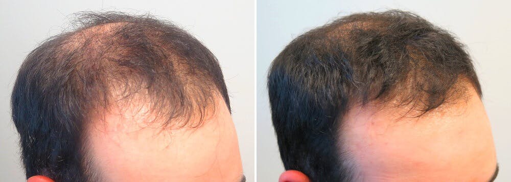 Saw Palmetto Capsules for Hair Loss – Hair Thickness Maximizer