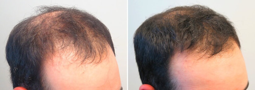 Finasteride before and after 12 months photo 1