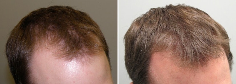 Finasteride before and after 12 months photo 10