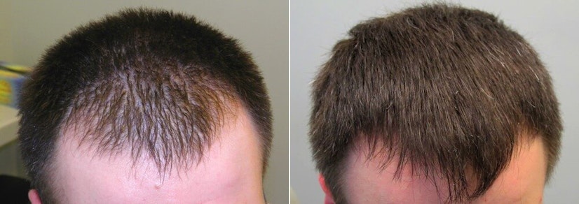Finasteride before and after 12 months photo 11