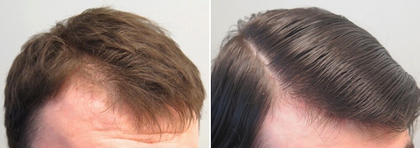 Finasteride before and after 12 months photo 13