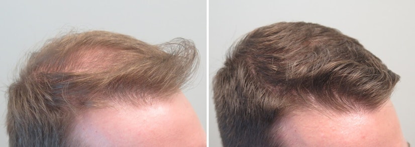 Finasteride before and after 12 months photo 14