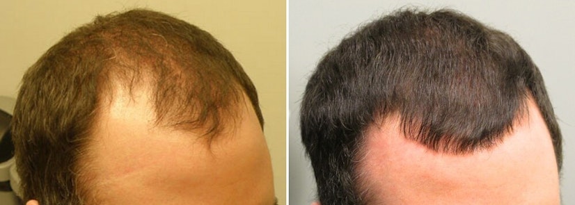 Finasteride before and after 12 months photo 2