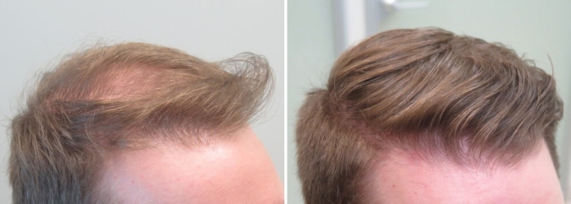 Finasteride before and after 12 months photo 3