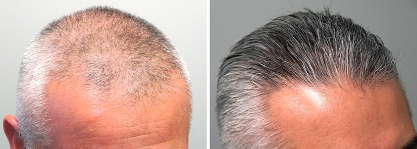 Finasteride before and after 12 months photo 4