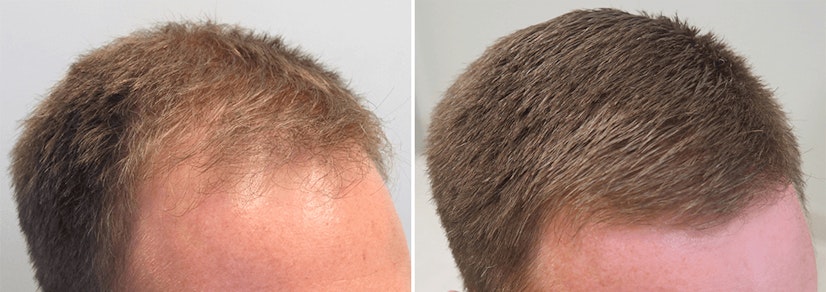 Finasteride before and after 12 months photo 5