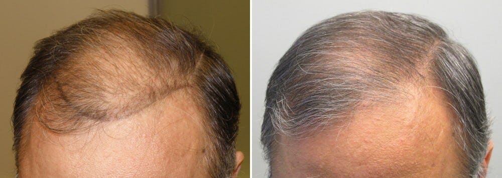 Finasteride Before And After Photos [2024]