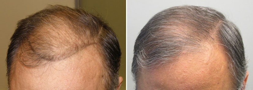 Finasteride before and after 12 months photo 6