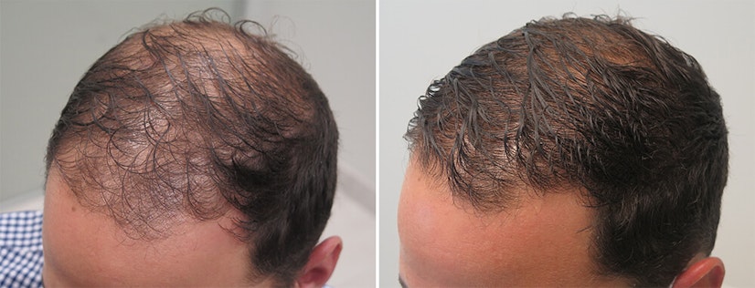 Finasteride before and after 12 months photo 7