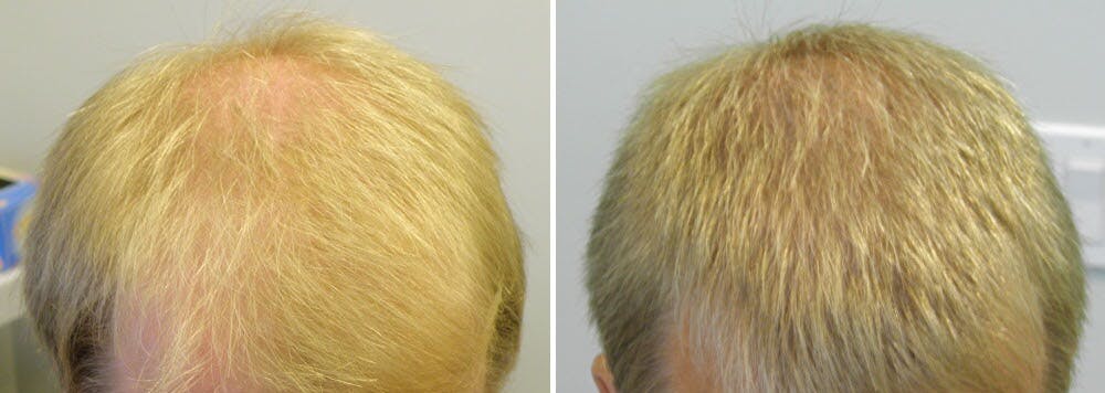 Finasteride Before And After Photos [2024]