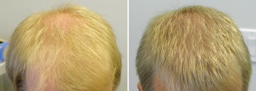 Finasteride before and after 12 months photo 8