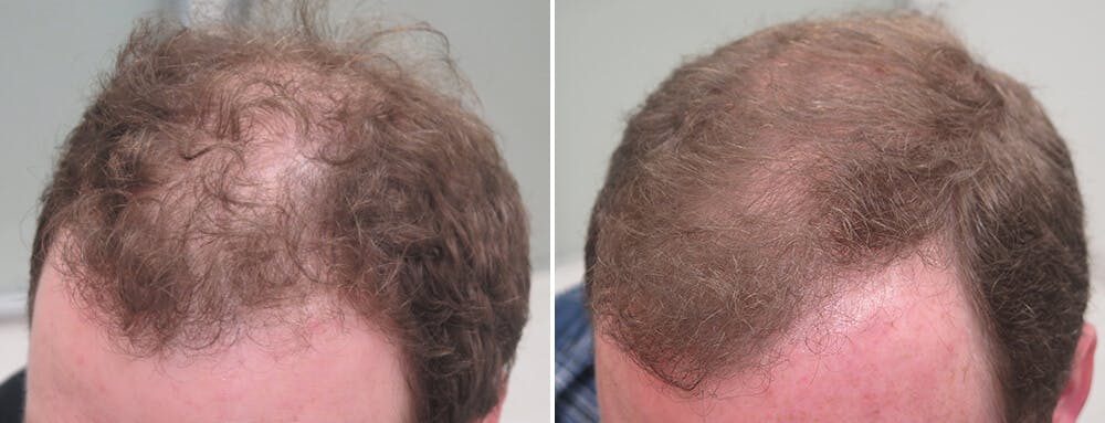 Finasteride Before And After Photos 2024   Finasteride Before And After 12 Months 9 