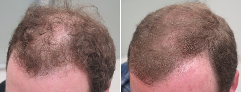 Finasteride before and after 12 months photo 9