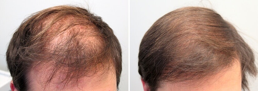 Finasteride before and after photo 15 months