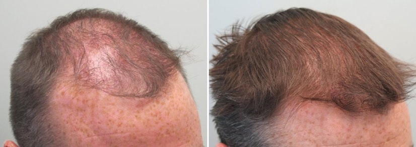 Finasteride before and after photo 16 months
