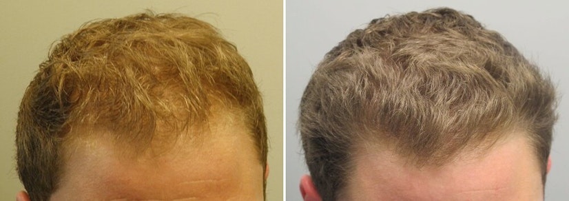 Finasteride before and after photo 16 months example 2
