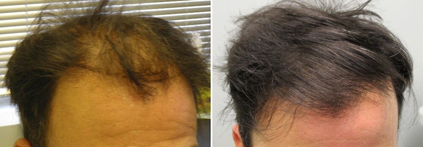 Finasteride before and after photo 16 months example 3