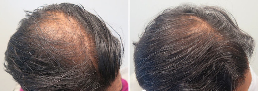 Finasteride 24 month difference