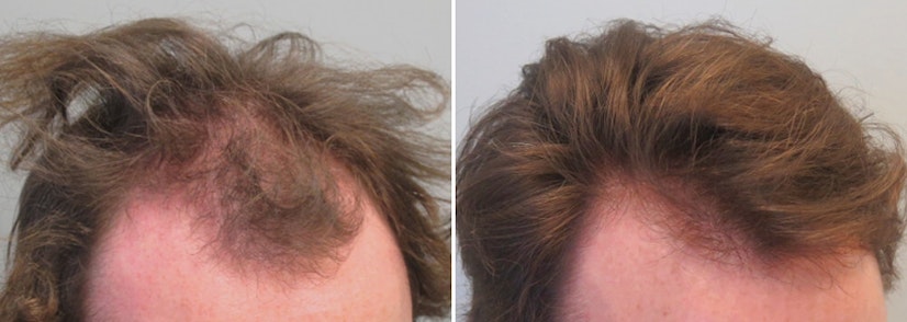 Finasteride before and after 48 months