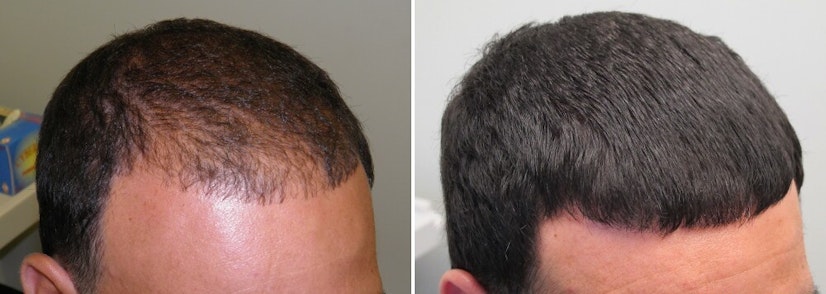 Finasteride 4-6 month before and after photo