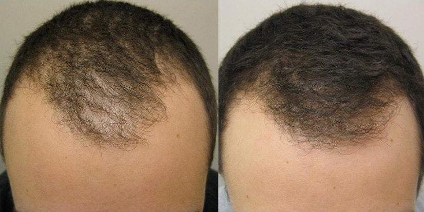 Finasteride 4-6 month before and after photo 3