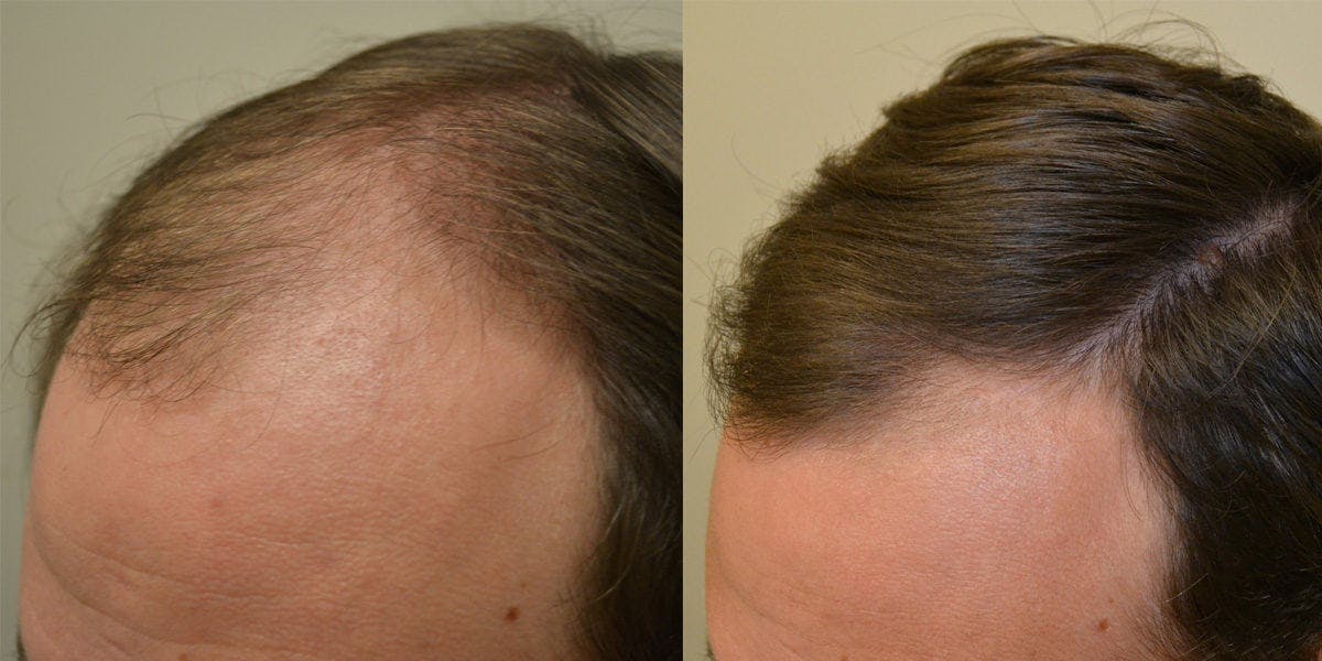 Finasteride Before and After Photos [2023]