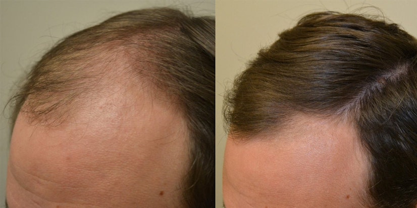 Finasteride 4-6 month before and after photo 4