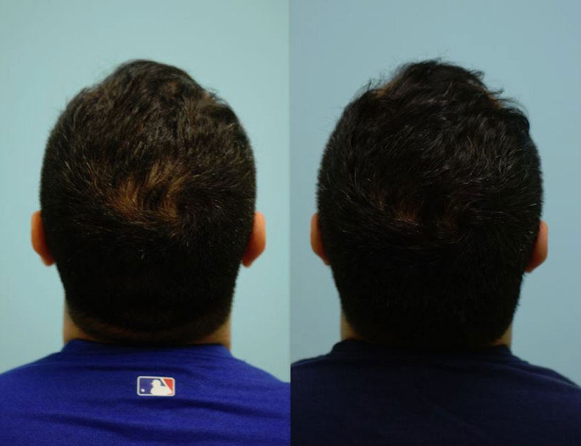 Finasteride 4-6 month before and after photo 2