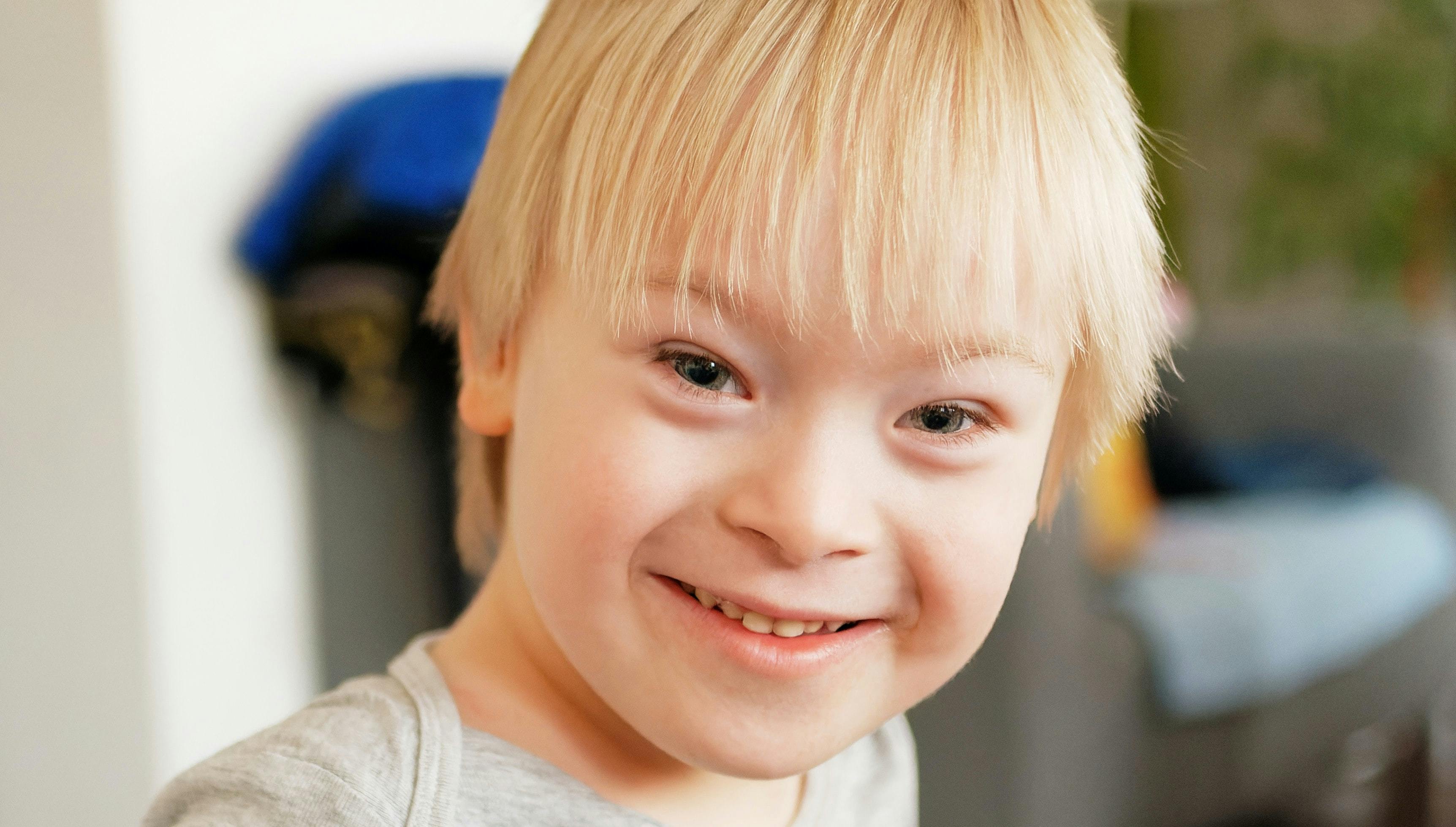 people with translocation down syndrome