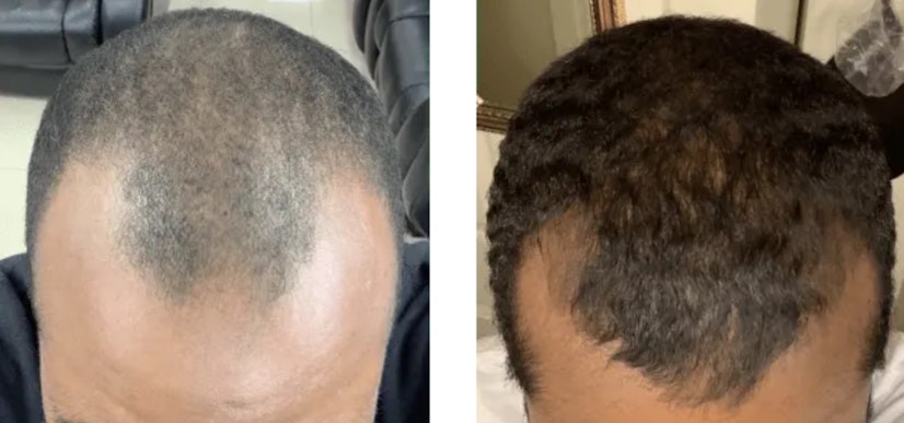 Minoxidil before and after 2 months