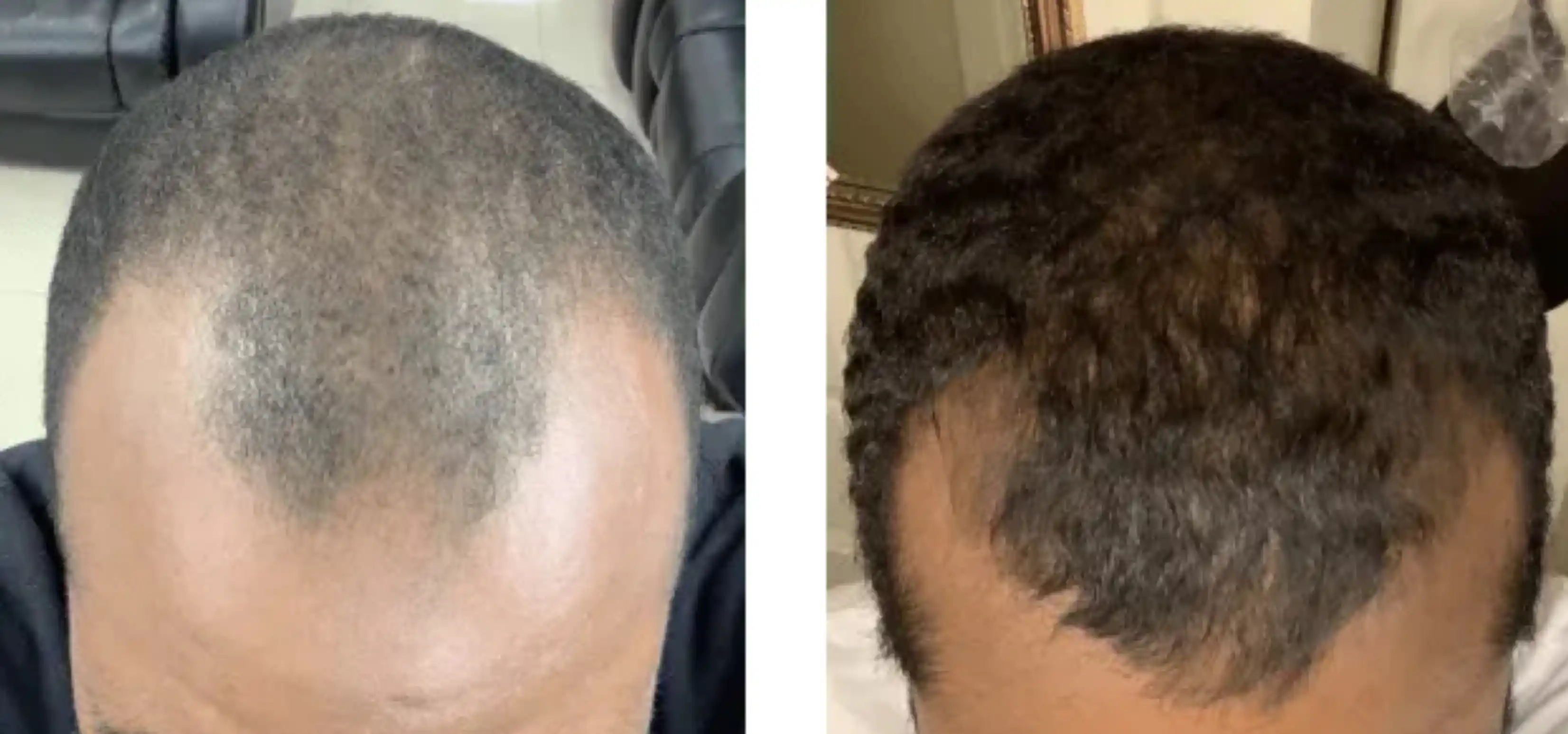 Minoxidil Before And After Photos 2024 Is It Right For You minoxidil-before-and-after-photos-2024-is-it-right-for-you