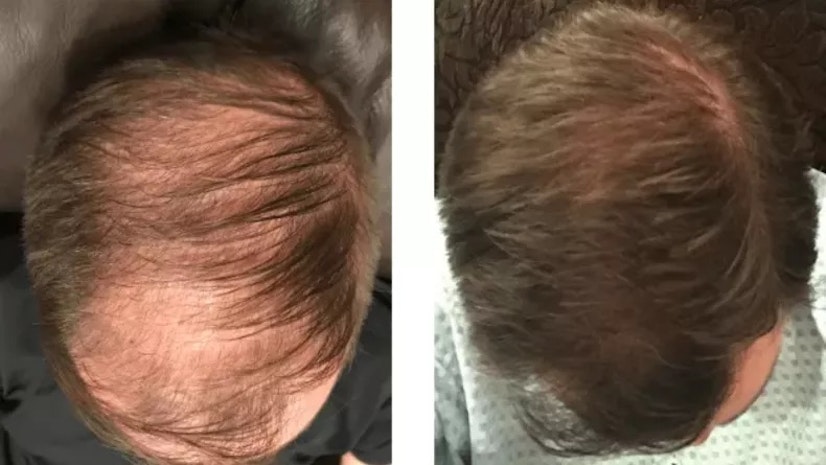 Minoxidil before and after 3 months example 2