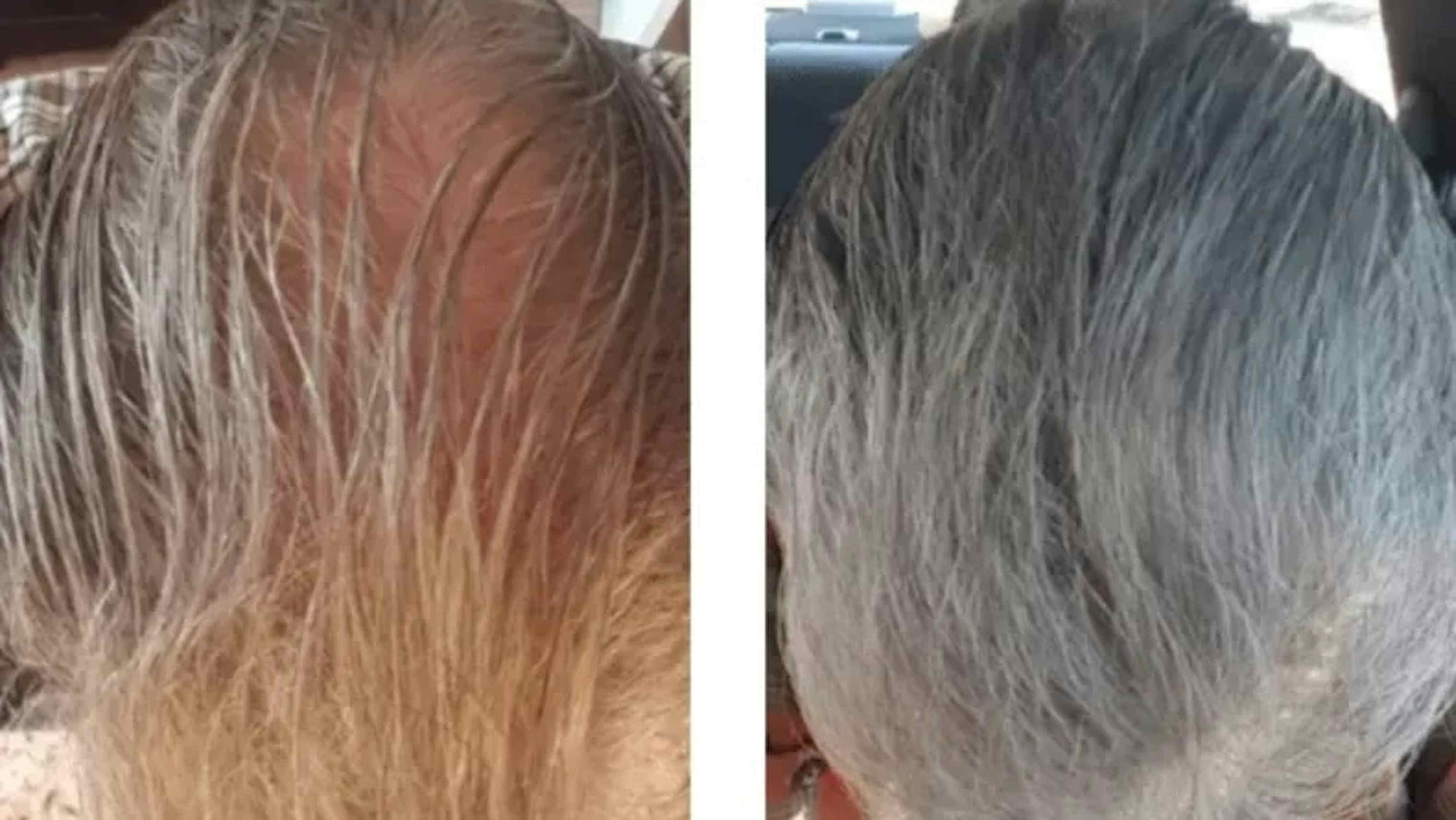 Minoxidil Before And After Photos 2025 Is It Right For You minoxidil-before-and-after-photos-2025-is-it-right-for-you