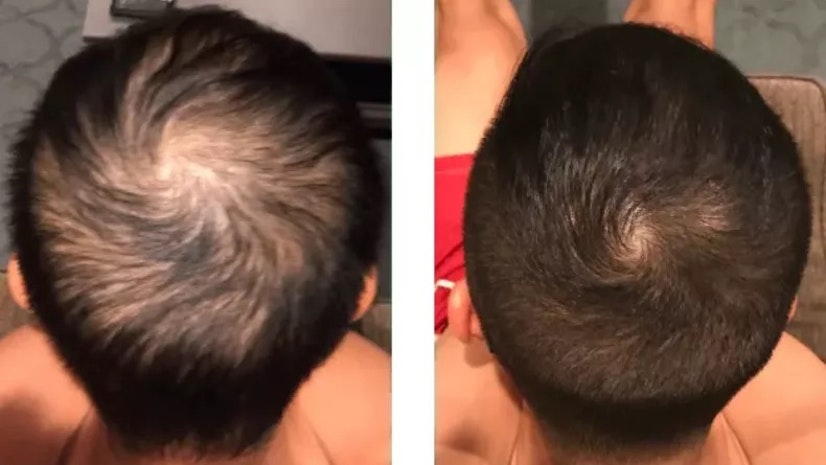 Minoxidil before and after 5 months
