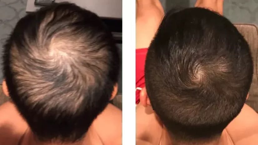 Minoxidil Before and Photos [2023] Is it for you?