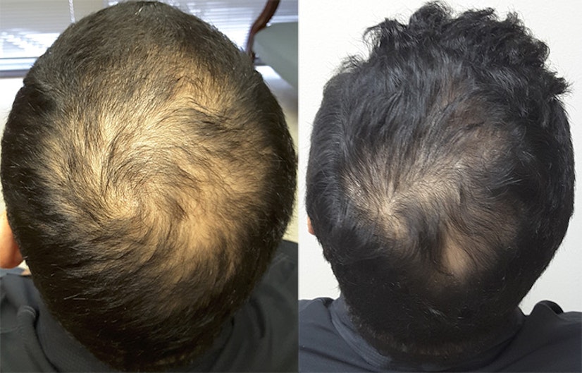 Minoxidil before and after 7 months