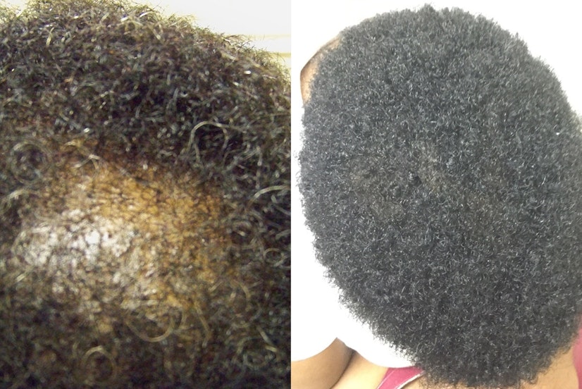 Minoxidil before and after 9 months