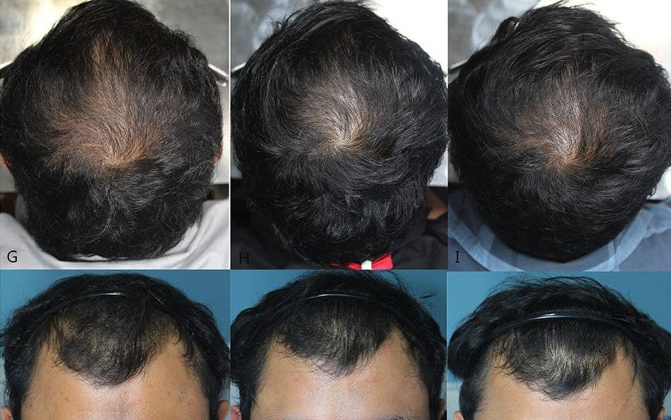 Oral minoxidil before and after photos of a man (left to right) at outset, 12 weeks, and 24 weeks - showing crown and hairline
