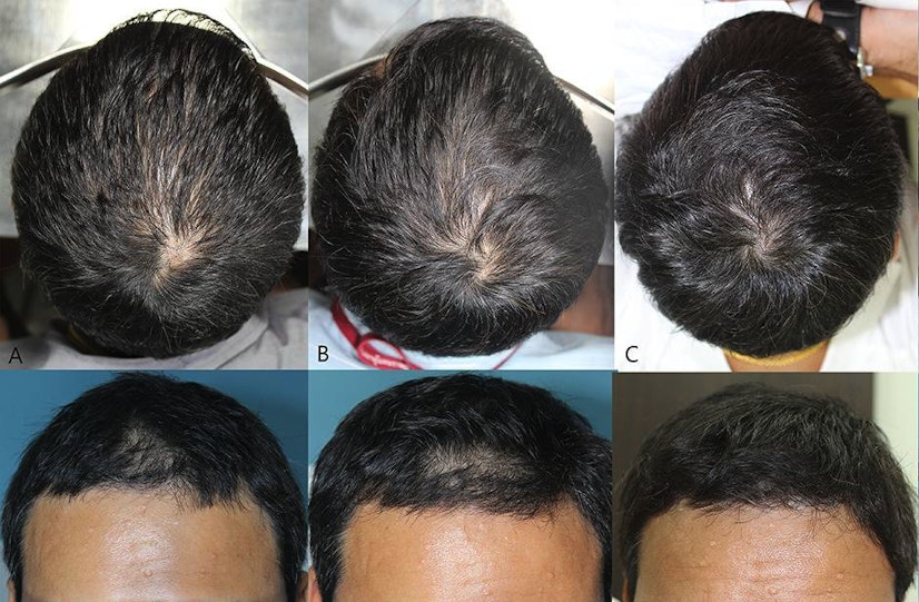 Oral minoxidil before and after photos of a man at the start of treatment, after 12 weeks, and after 24 weeks - showing crown and hairline