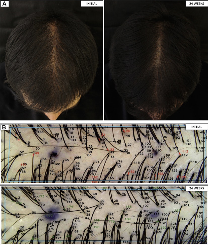 Oral minoxidil before and after photos - 24 weeks of treatment, showing crown and follicle density