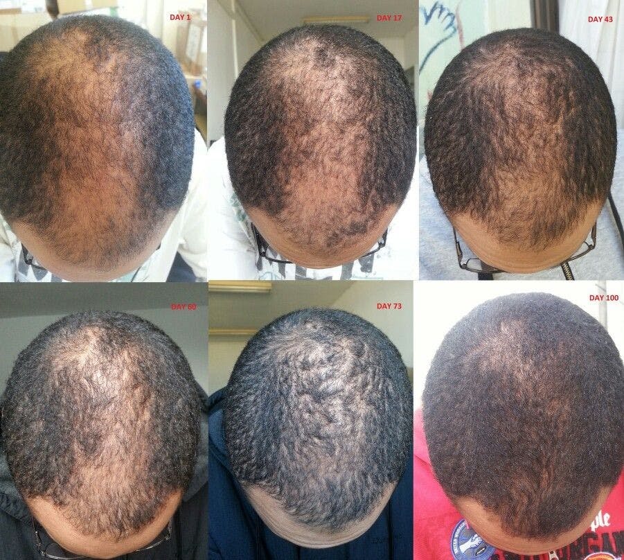 Mintop gain 5% solution – Adon Hair Care