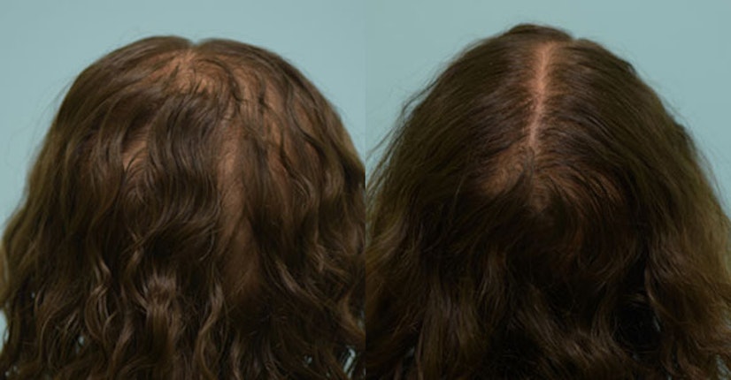 Minoxidil before and after 3 months