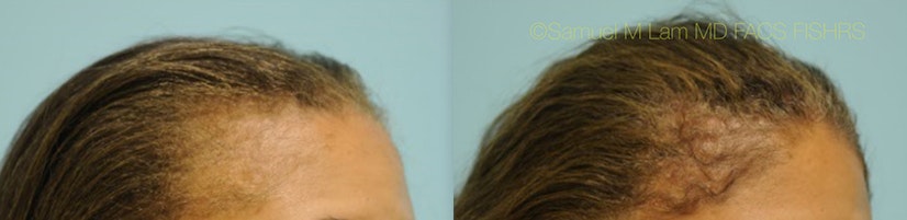 Minoxidil before and after 4 months