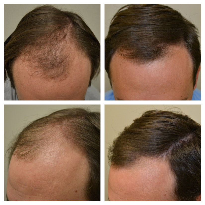 Minoxidil before and after 6 months