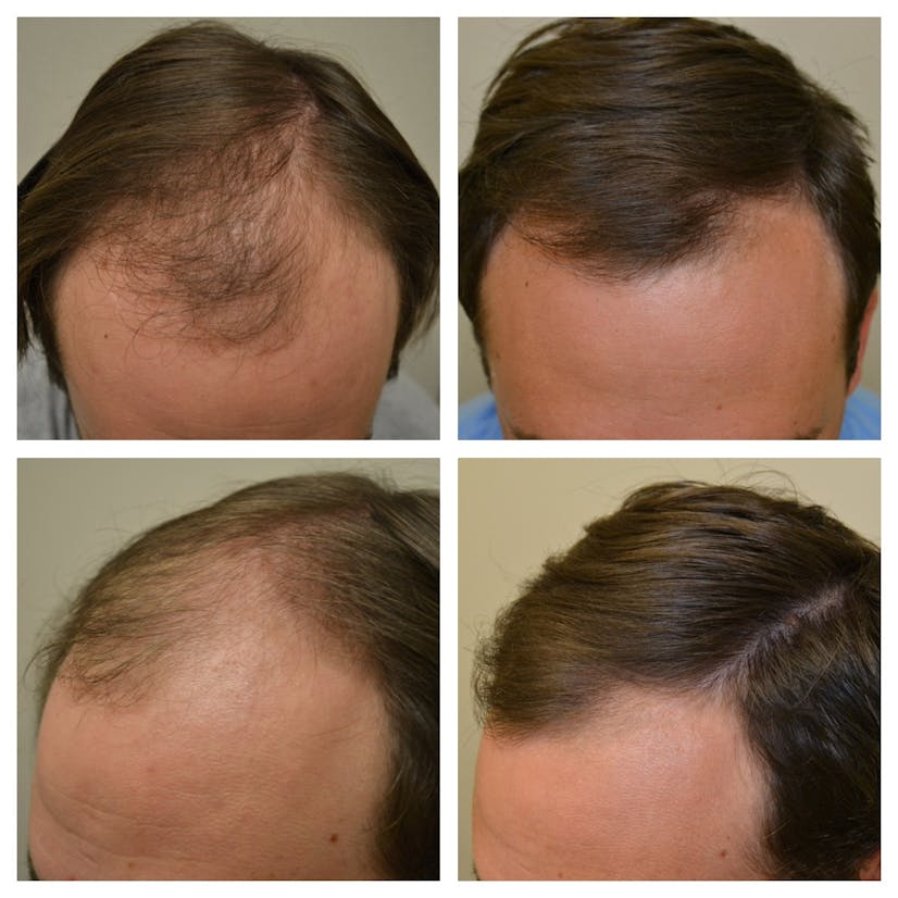 Minoxidil Before And After Photos [2024] Is It Right For You