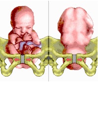 Normal Birth vs. Breech Birth