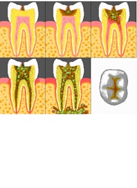 Teeth - Dental Cavities
