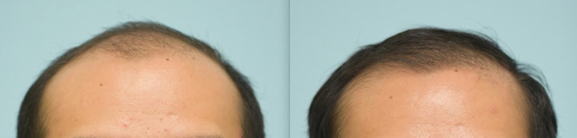 Topical finasteride and minoxidil before and after 10 months