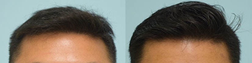 Topical finasteride and minoxidil before and after 5 months photo 2