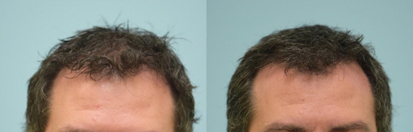 Topical finasteride and minoxidil before and after 5 months